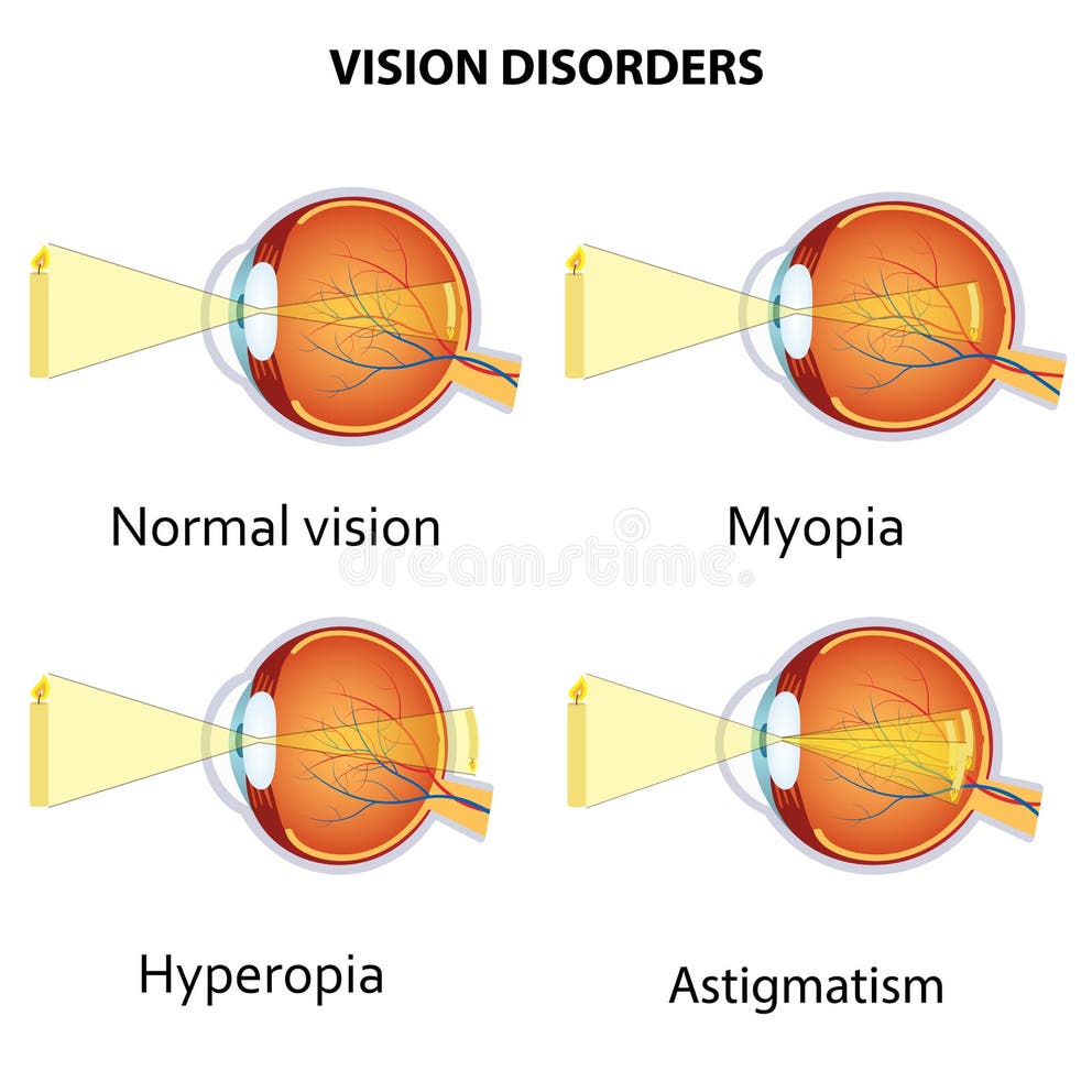 How to Improve Farsightedness Naturally